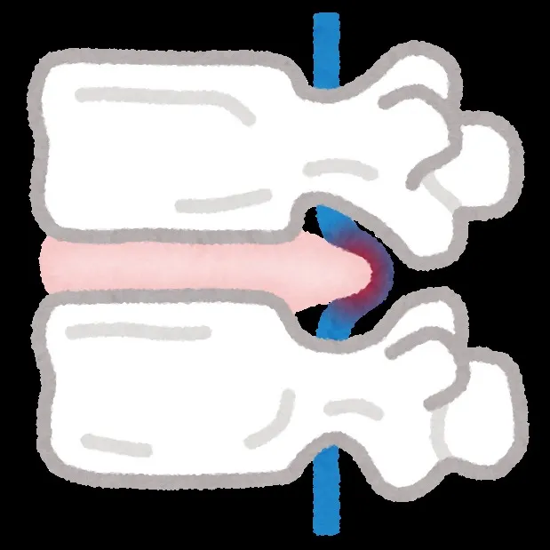 ヘルニアとは何らかの原因で椎間板の線維輪が破れて、髄核が外に...