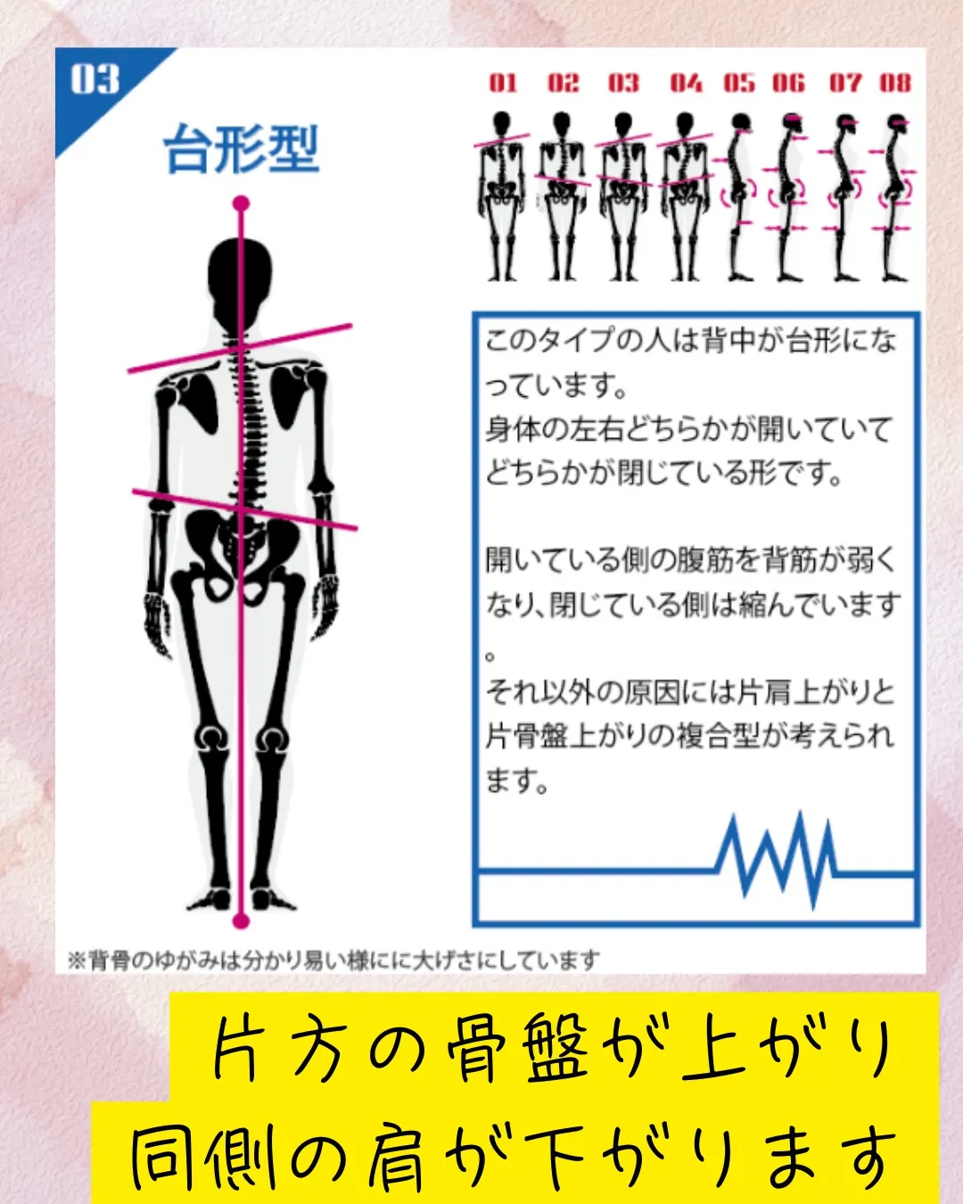 姿勢分析をする中で多い歪み方の台形。
