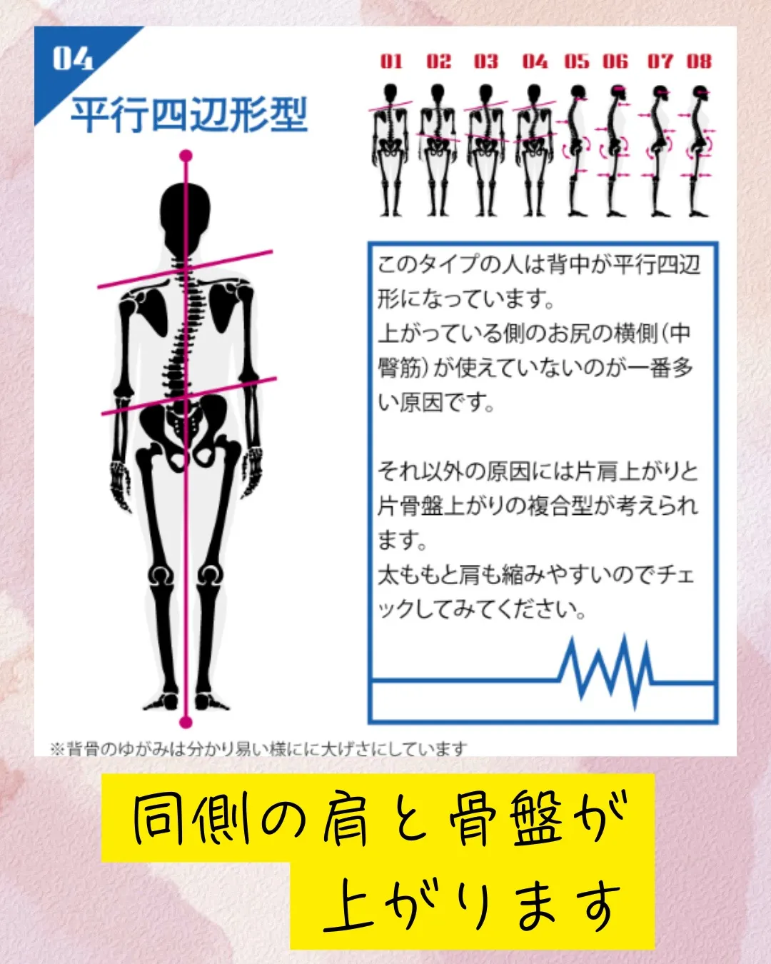 平行四辺形は足のしびれが出やすいです。