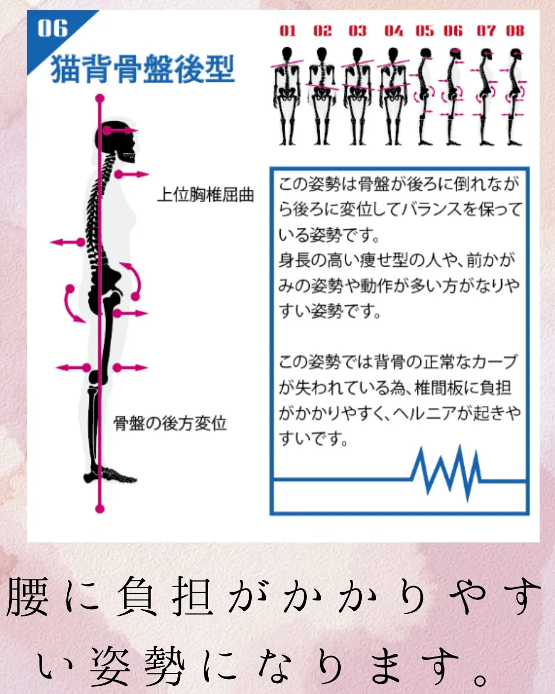 今日は8つあるうちの6つ目、猫背骨盤後型。