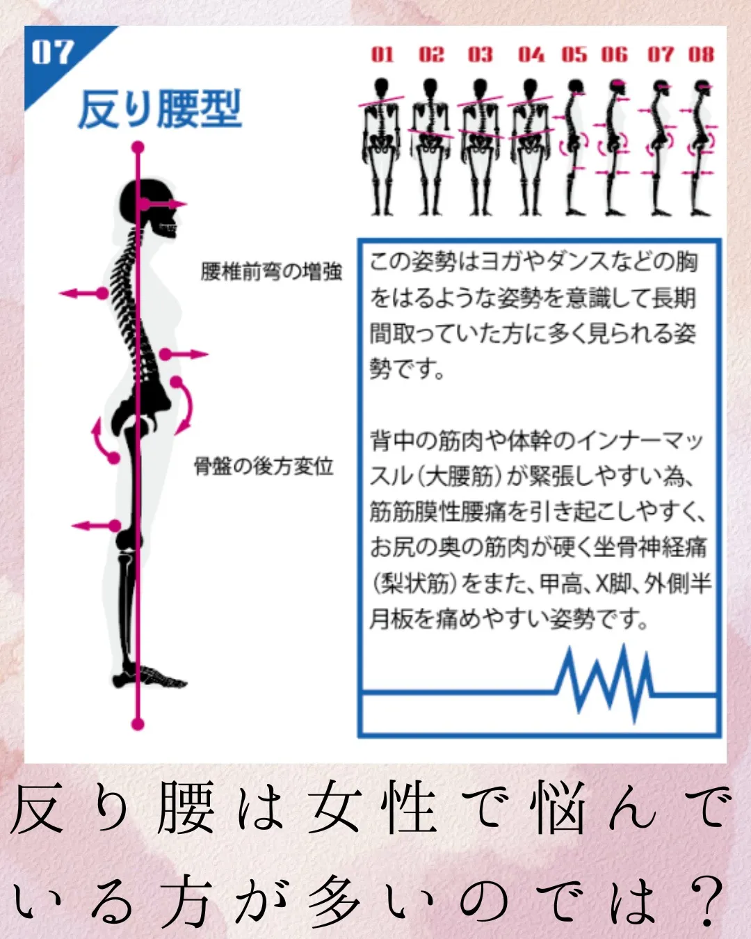 反り腰は悩んでいる方多いですよね。