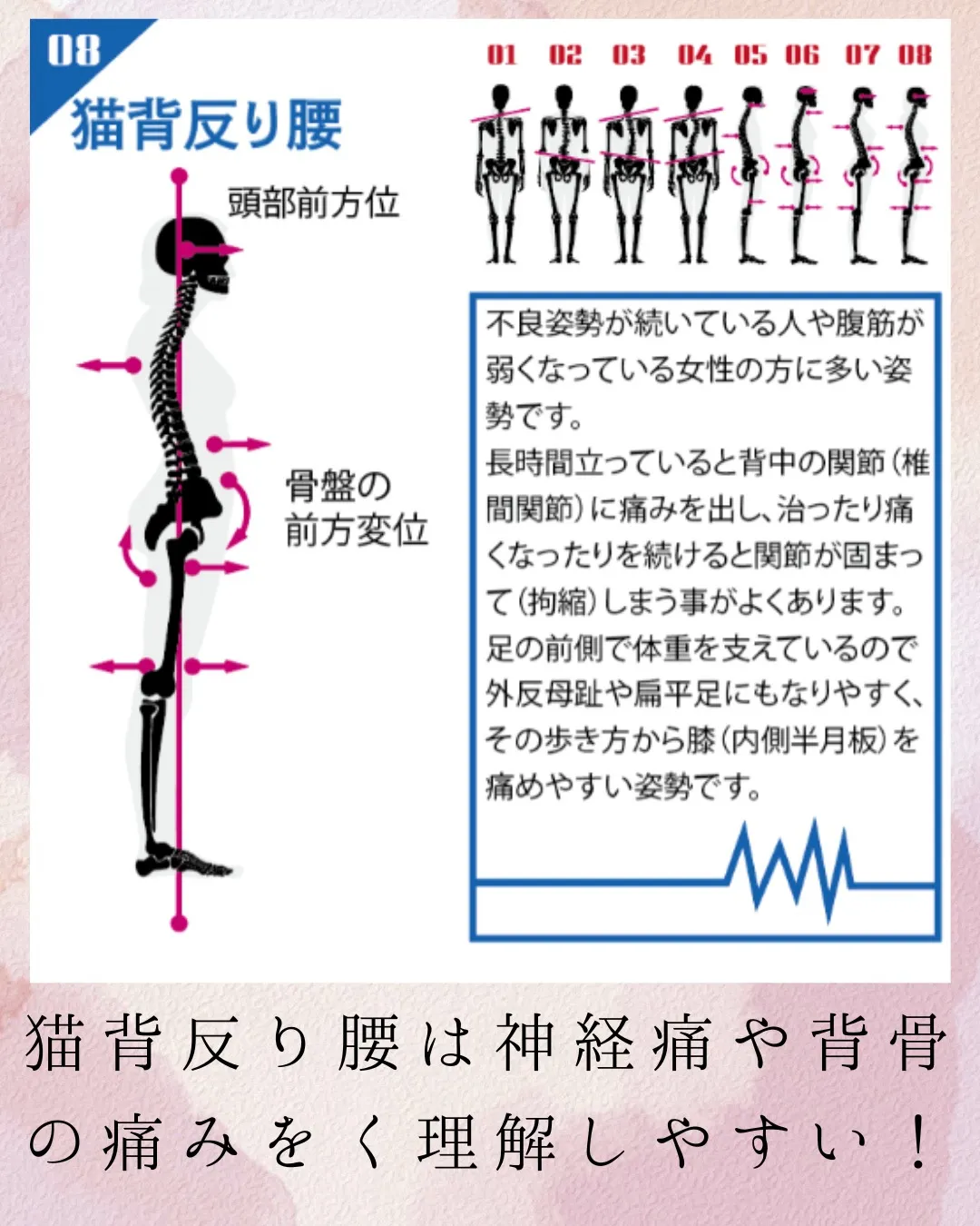 今日は8分類最後の猫背反り腰型。
