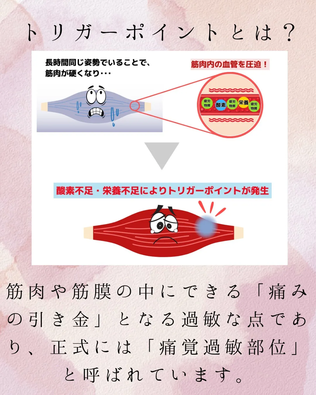 当院でおこなっている施術、トリガーポイント療法。