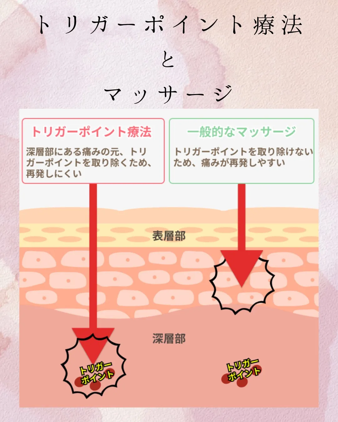 当院でおこなっている施術、トリガーポイント療法。